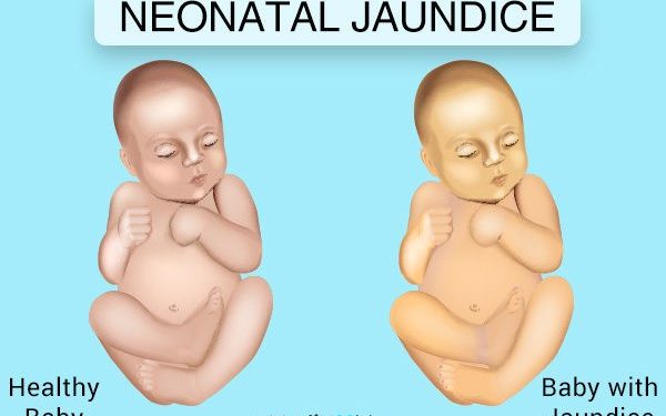Neonatal Jaundice Could Lead To Permanent Brain Damage If Left Untreated – Paediatric Nurse