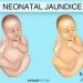 Neonatal Jaundice Could Lead To Permanent Brain Damage If Left Untreated – Paediatric Nurse