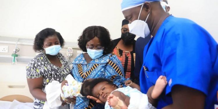 Government to pay for siamese twins seperation surgery