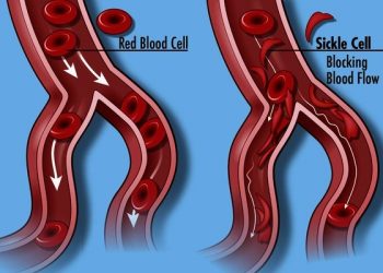Early Diagnosis Key To Dealing With Sickle Cell Disease – Public Health Nurses