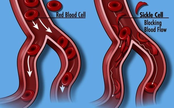 Early Diagnosis Key To Dealing With Sickle Cell Disease – Public Health Nurses