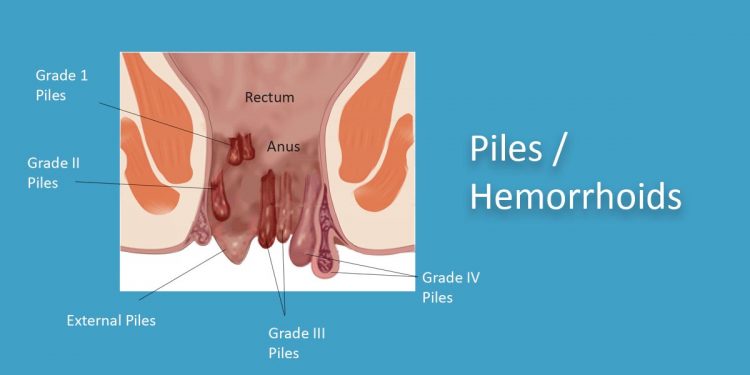 Healthy Diet And A Healthy Lifestyle Reduces The Risk Of Haemorrhoids (Piles) – Doctor Advises