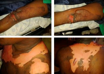 Department of Social Welfare Rescues Burnt Girl Selling Lime Under Hot Sun