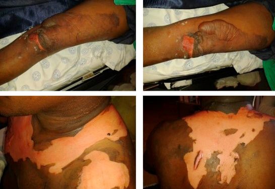 Department of Social Welfare Rescues Burnt Girl Selling Lime Under Hot Sun