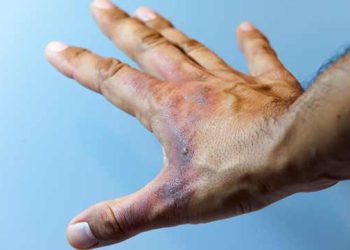 Ghanaians Urged To Be More Concern About Preventing Burns Than Managing It