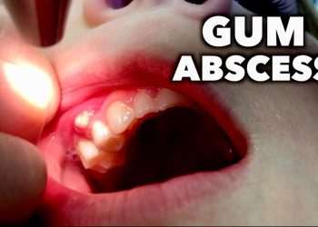 Abscessed Gum kills; Treat It With Urgency When You See Signs