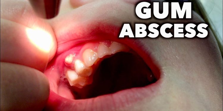 Abscessed Gum kills; Treat It With Urgency When You See Signs