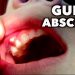 Abscessed Gum kills; Treat It With Urgency When You See Signs
