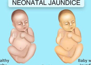 Early Morning Sunset is No Confirmed Treatment For Neonatal Jaundice- Tema General Hospital