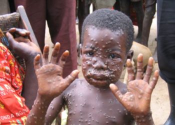 5 Cases Of Monkeypox Confirmed In Ghana