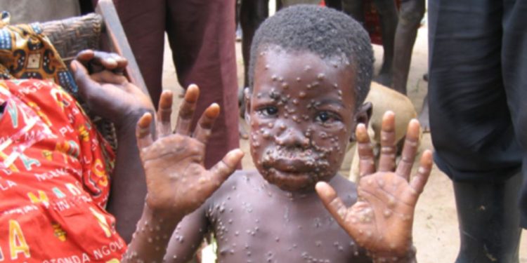 5 Cases Of Monkeypox Confirmed In Ghana