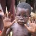 5 Cases Of Monkeypox Confirmed In Ghana
