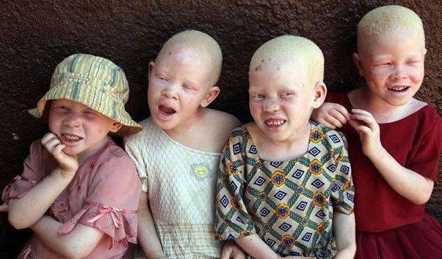 Mozambican Caught ‘Planning Albino Children Sale’