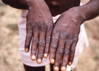 Upper East Region: Military Officer Dies Of Monkeypox