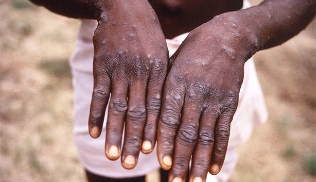 Upper East Region: Military Officer Dies Of Monkeypox