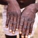 Upper East Region: Military Officer Dies Of Monkeypox
