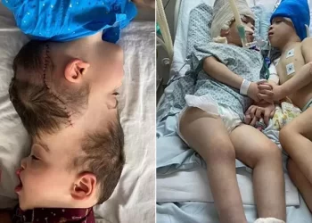 ‘Space-age stuff’: Conjoined Twins Separated With Help Of Virtual Reality In Brazil