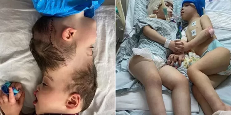 ‘Space-age stuff’: Conjoined Twins Separated With Help Of Virtual Reality In Brazil