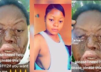 Weija: Boyfriend pours acid on his beautiful girlfriend