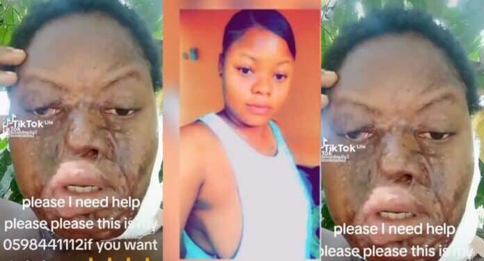 Weija: Boyfriend pours acid on his beautiful girlfriend