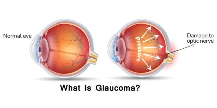 See tomorrow: Don’t let Glaucoma steal your sight – Nursing Officer